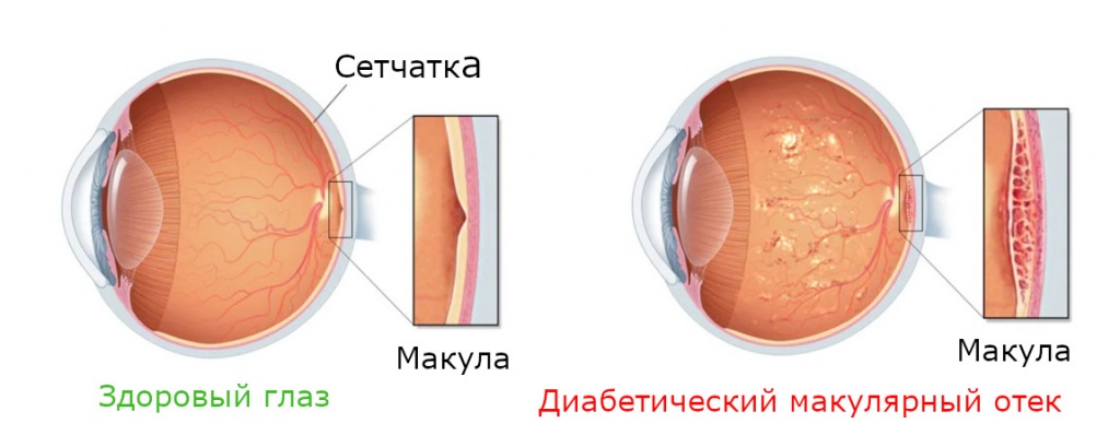 macularniy-otek-big.jpg