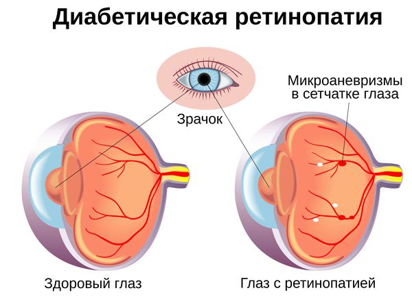 priznaki-diabeticheskoy-retinopatii_s.jpg